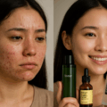 10 Best Korean Skincare For Acne Scars